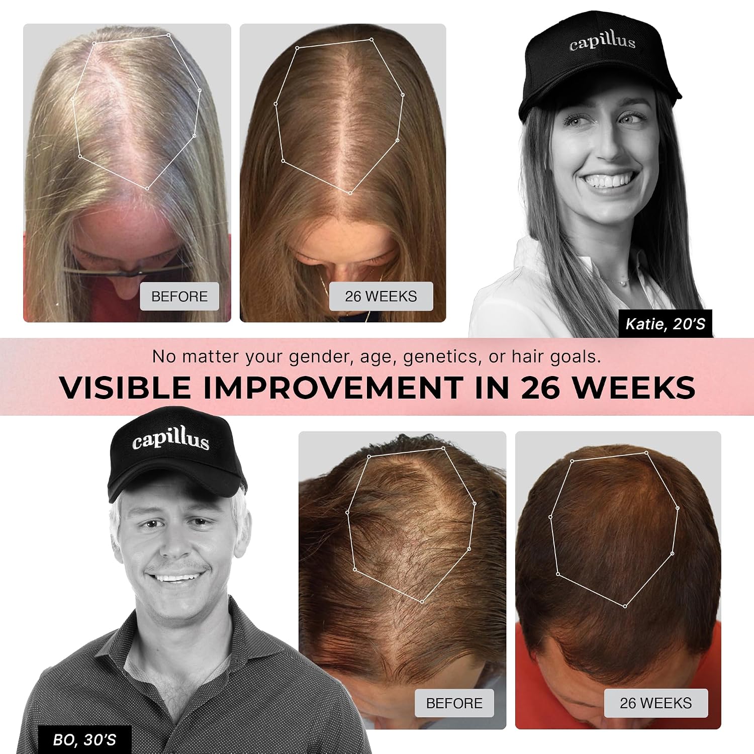 CapillusPro Clinical Hair Growth Laser Cap photo 5
