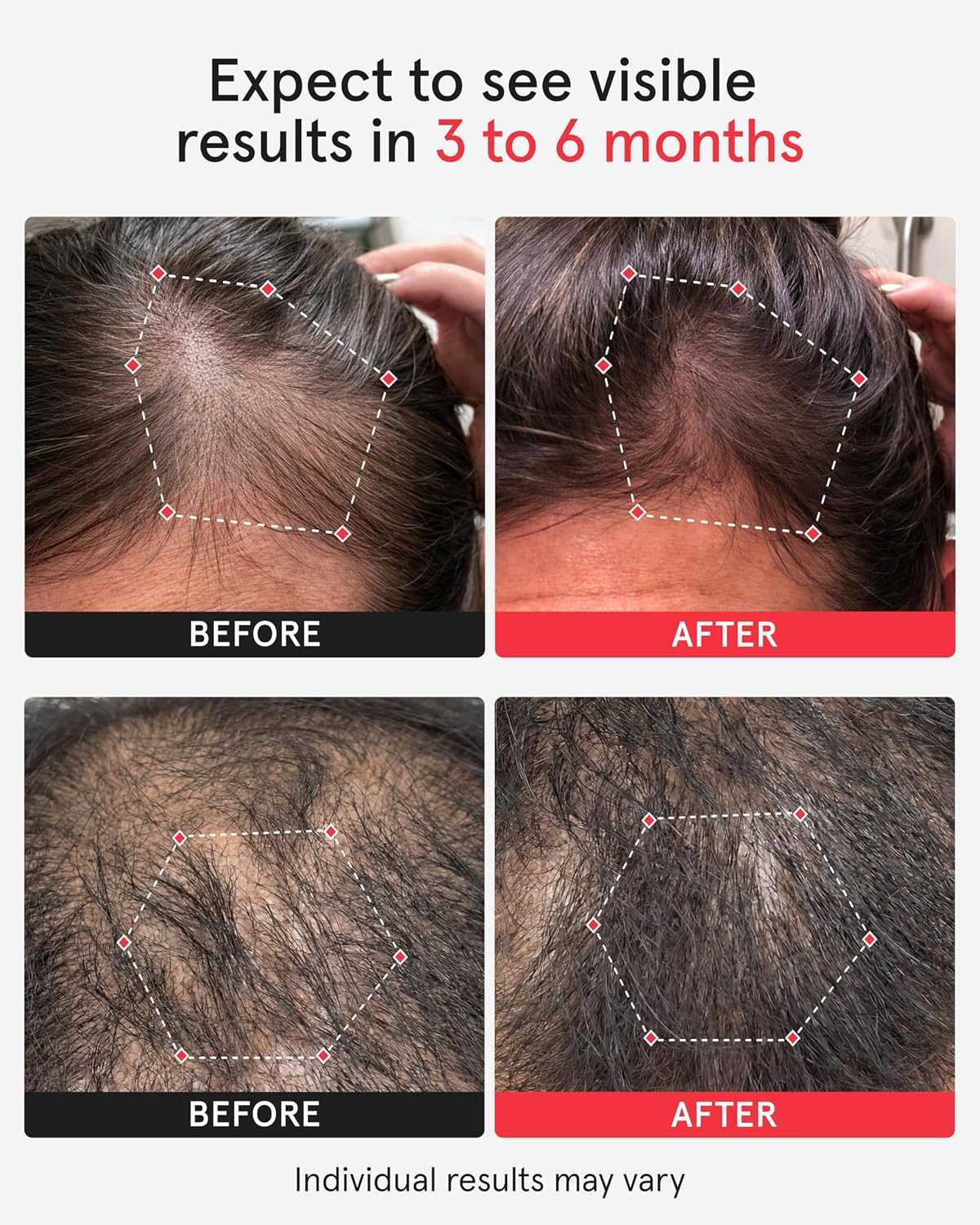 iRestore Professional Laser Hair Growth Helmet photo 2