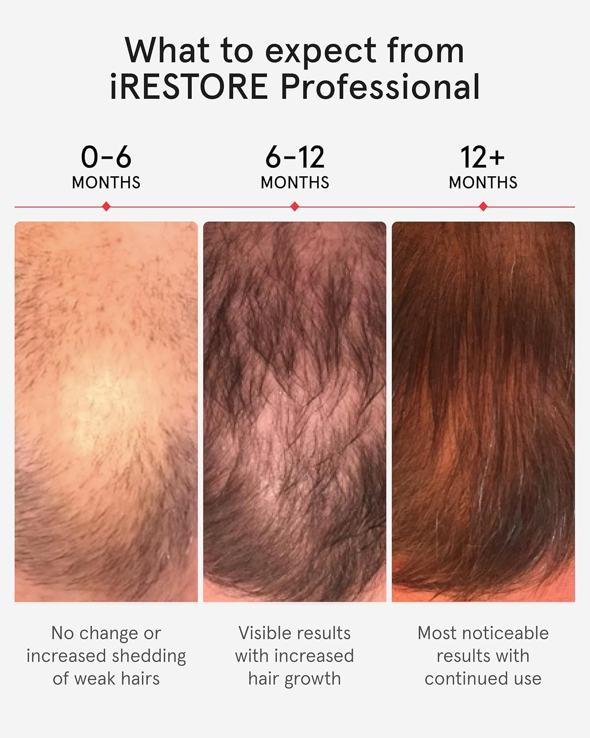 iRestore Professional Laser Hair Growth Helmet photo 3